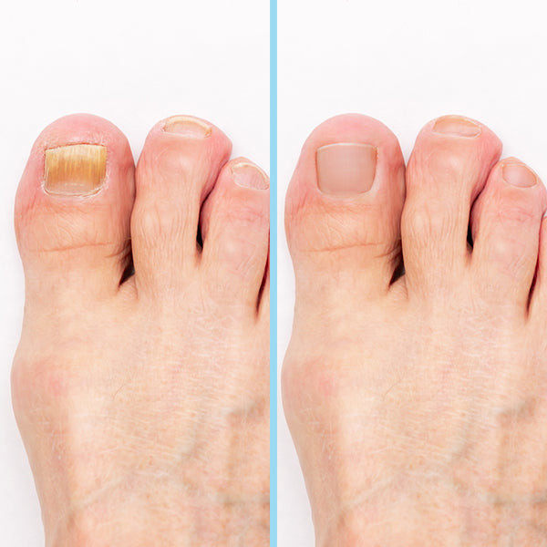 IZA Effect Spray anti-mycoses des pieds et des ongles
