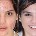 Vor und nach der Anwendung con Cell-1 Skin Care Schneckencreme