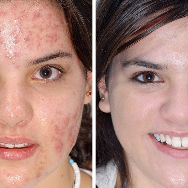 Vor und nach der Anwendung con Cell-1 Skin Care Schneckencreme