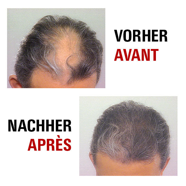 Power Grow Max - Système pour une nouvelle croissance de cheveux