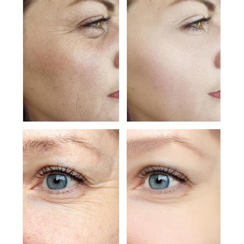 Velform Renew Kit anti-âge à l'acide hyaluronique