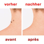 Wurzelbehandlung vorher nachher