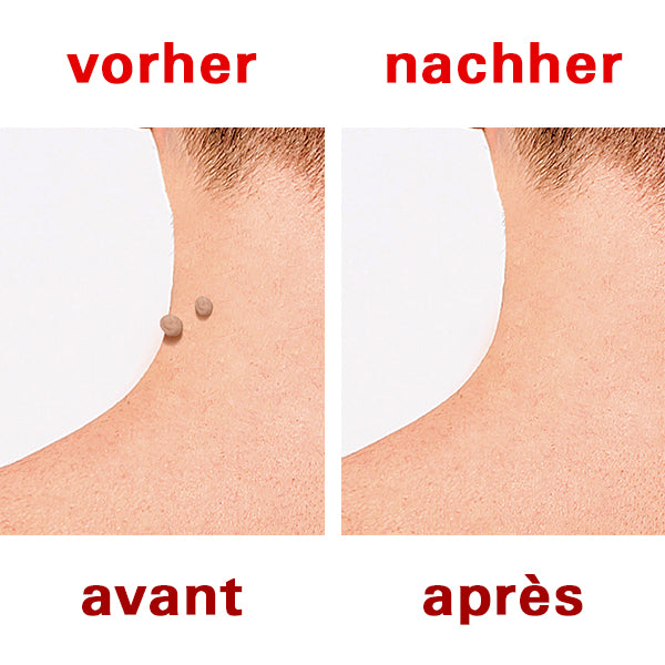 Wurzelbehandlung vorher nachher