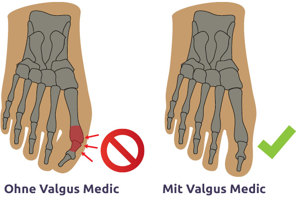 Valgus Medic