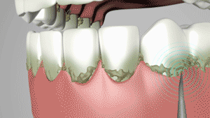 Zahn- und Zungenreiniger
