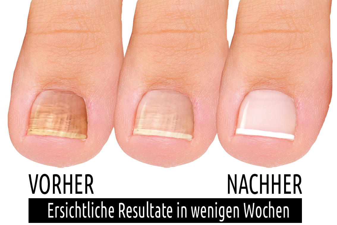 Nagelpilz und Kalknägel Behandlung mit Medonail vorher/nachher